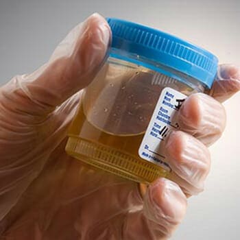 Urine in hand