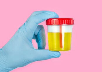 urine sample in a cup