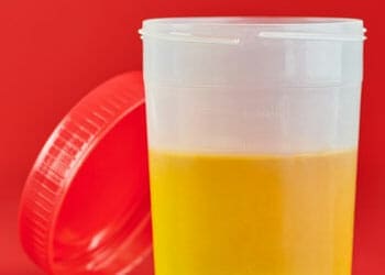 Urine in a cup