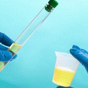 A urine sample with two containers 