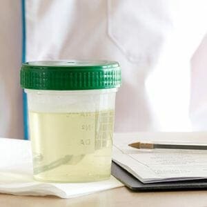 A urine sample in a sealed container for urine test